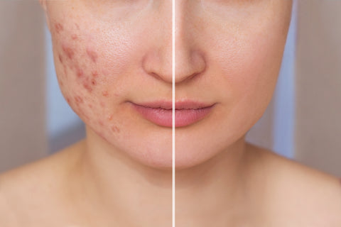 How to remove acne?